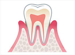 軽度歯周炎
