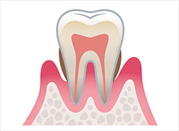 中度歯周炎